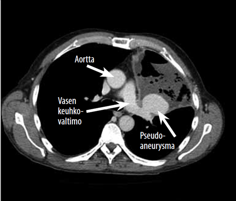 Keuhkovaltimon pseudoaneurysma