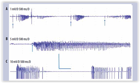 Myotonia lihaksen ionikanavataudeissa