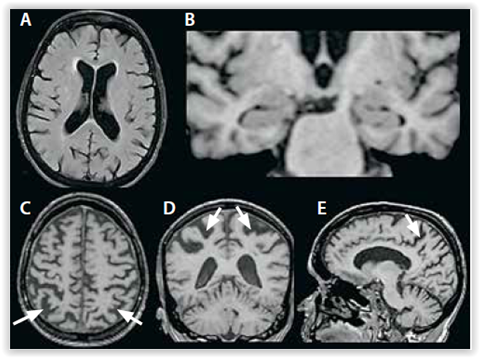 Alzheimerin Taudin Varhainen Tunnistaminen