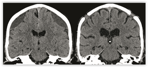 Aikuisten Krooninen Subduraalihematooma