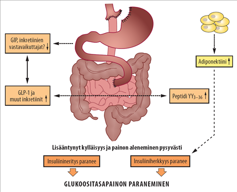 Miksi diabetes paranee mahanohitusleikkauksen jälkeen?