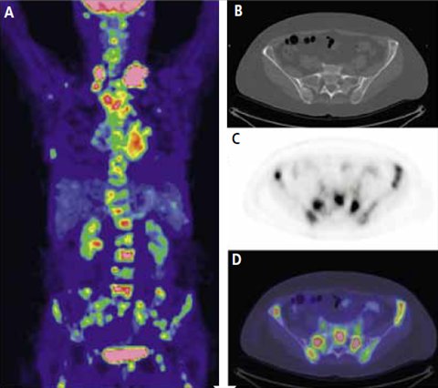 Positroniemissiotomografian ja tietokonetomografian yhdistelmä syövän  diagnostiikassa